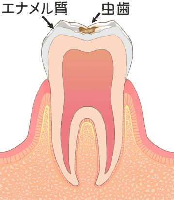 C1 歯の表面のむし歯