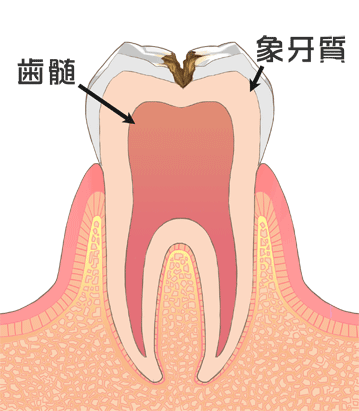C2 歯の中に達したむし歯